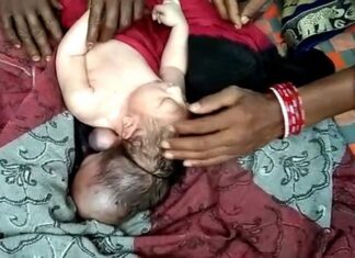 В Индии родился трехголовый младенец