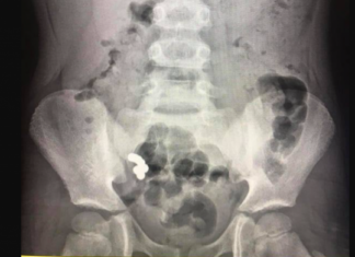 В Ивано-Франковской области мальчик проглотил семь магнитных шариков (фото)