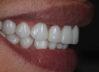 Установка безметалловой коронки: как происходит протезирование?